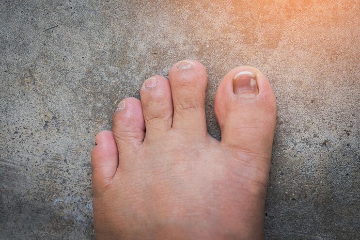 Nagelpilz