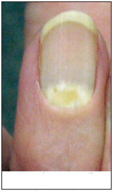 Proximal-Deforming Pilz