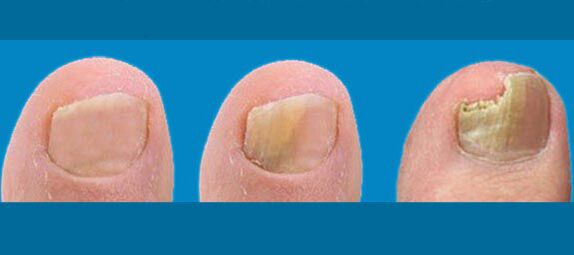 Stufen des Nagelpilzes