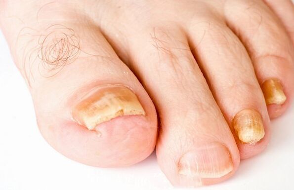 Formen von Nagelpilz