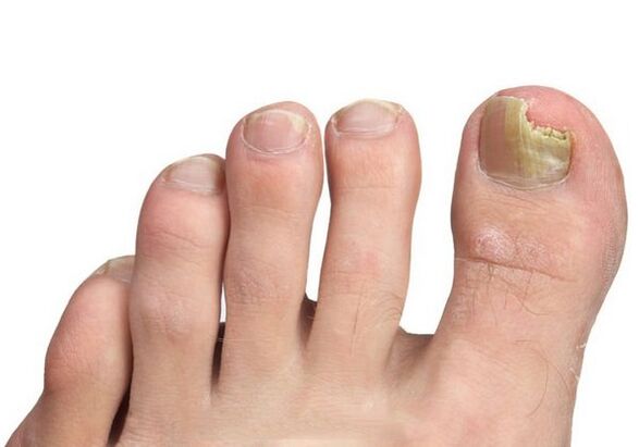 Ursachen für Nagelpilz