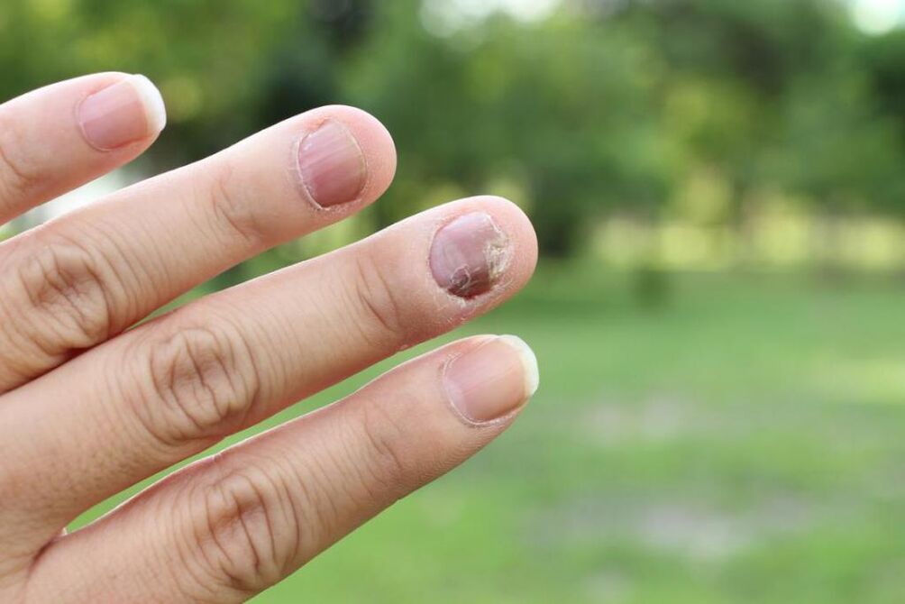 Fingernagelpilz