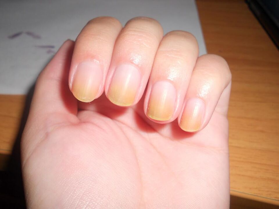Symptome eines Fingernagelpilzes