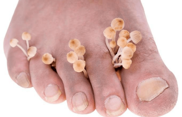 Pilzinfektion an den Füßen